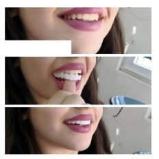 Snap på Smile Dental Veneers 1 Piece (Sæt op og ned)